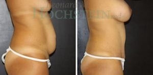 Mommy Makeover Patient