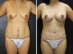 Mommy Makeover Patient