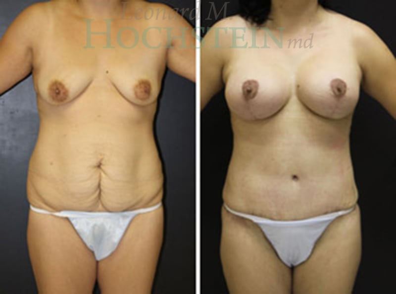 Mommy Makeover Patient