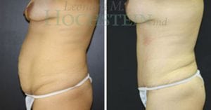 Mommy Makeover Patient