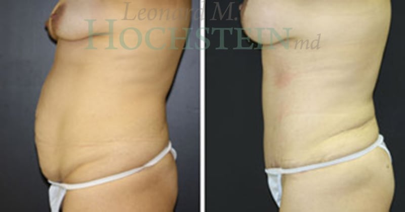 Mommy Makeover Patient