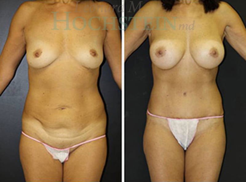 Mommy Makeover Patient