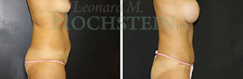 Mommy Makeover Patient