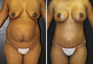 Mommy Makeover Patient