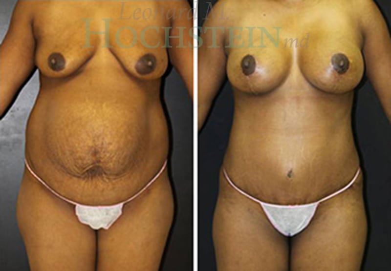 Mommy Makeover Patient