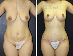 Mommy Makeover Patient