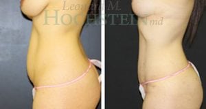 Mommy Makeover Patient