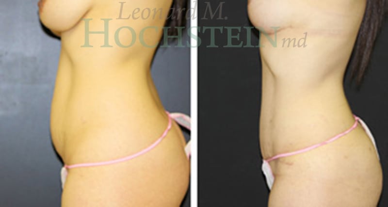 Mommy Makeover Patient