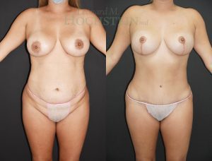 Mommy Makeover Patient 63