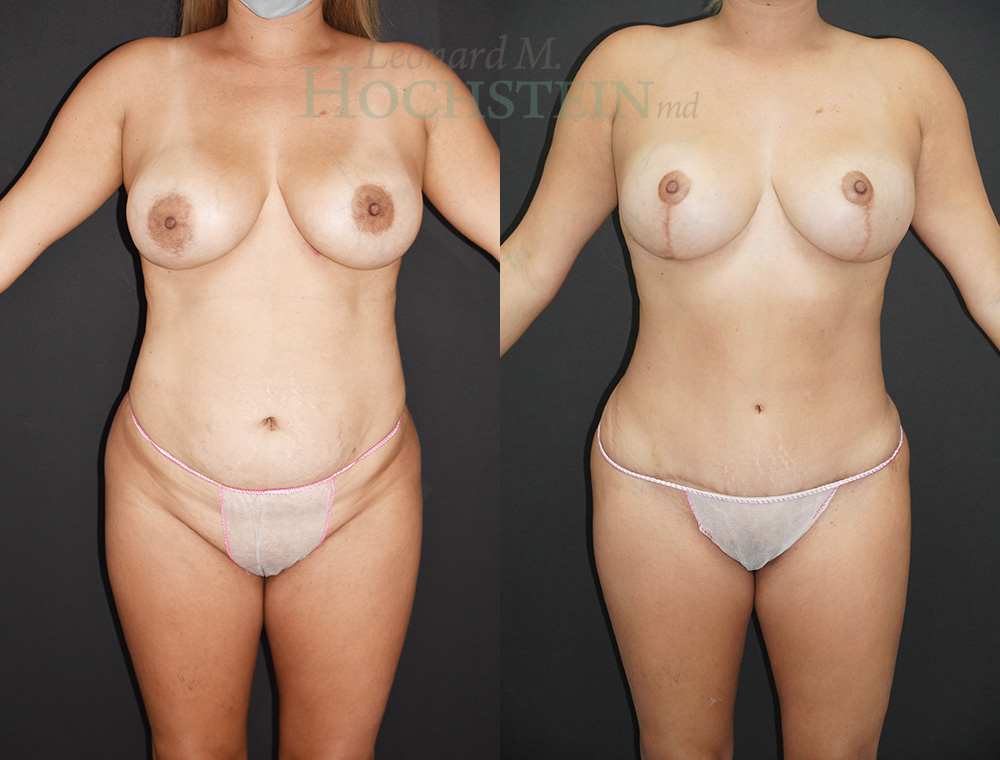 Mommy Makeover Patient