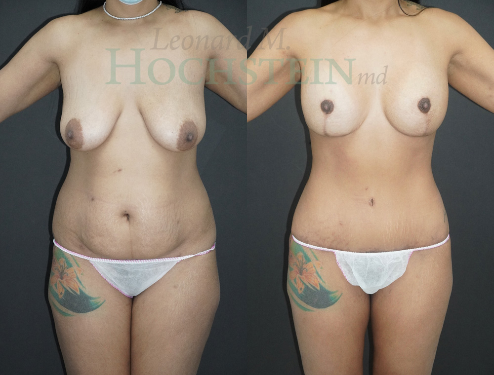 Mommy Makeover Patient