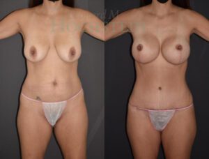 Mommy Makeover Patient 66