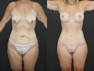 Mommy Makeover Patient 67