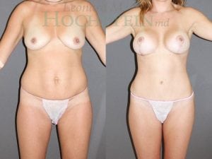 Mommy Makeover Patient