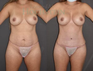 Mommy Makeover Patient 62