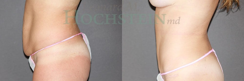 Mommy Makeover Patient