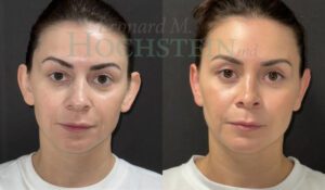 Otoplasty Patient 02