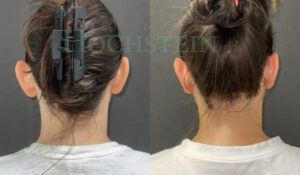 Otoplasty Patient