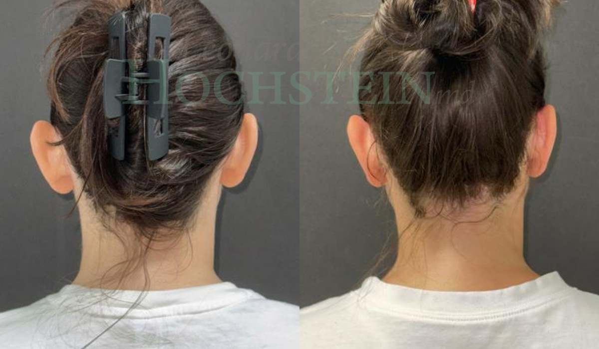 Otoplasty Patient