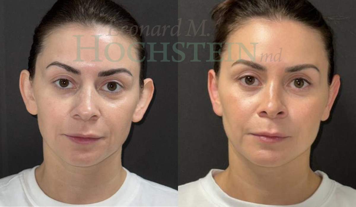 Otoplasty Patient