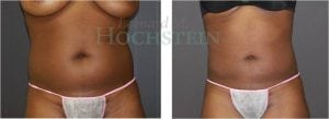 Liposuction Patient 34
