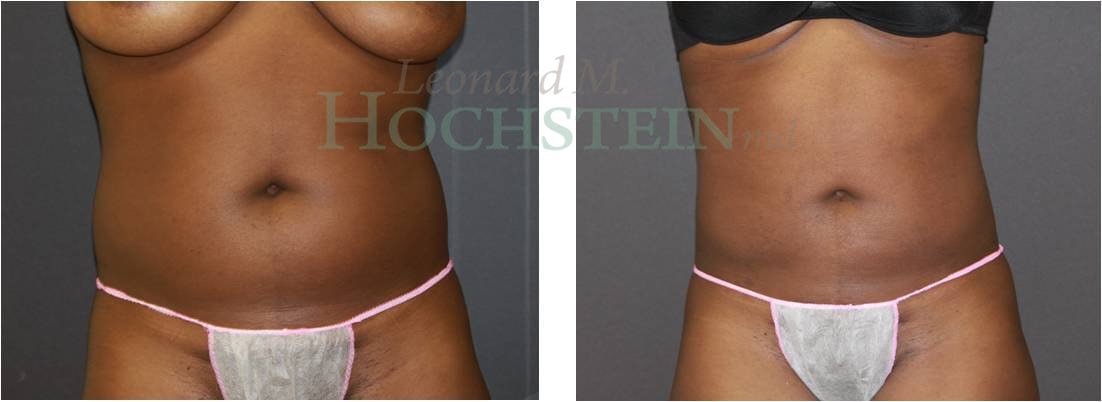 Liposuction Patient