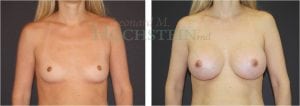 Breast Augmentation Patient