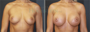 Breast Augmentation Patient