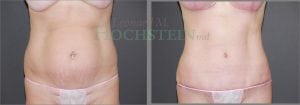 Tummy Tuck Patient 14