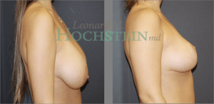 Breast Reduction/Lift (No Implants) Patient
