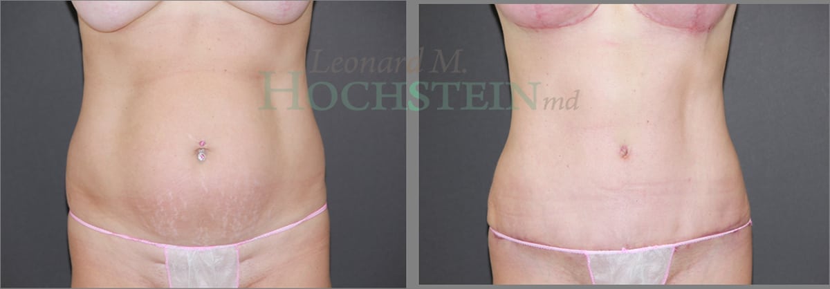 Tummy Tuck Patient