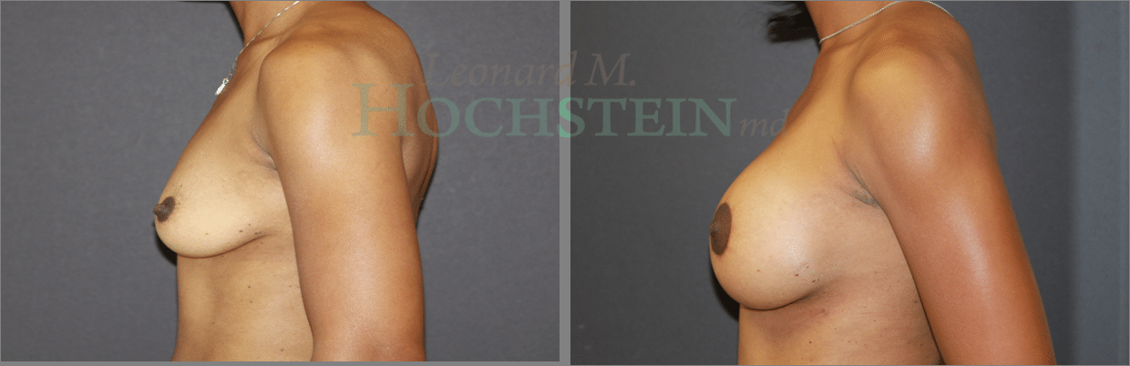 Breast Lift With Implants Patient