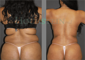 Liposuction Patient 36