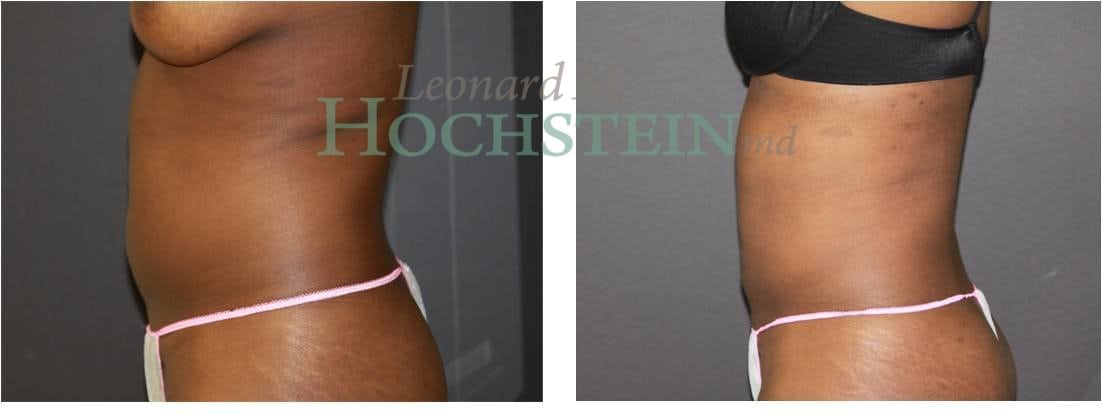 Liposuction Patient