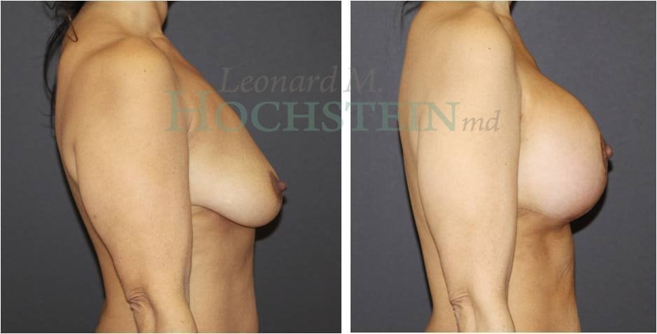 Breast Lift With Implants Patient