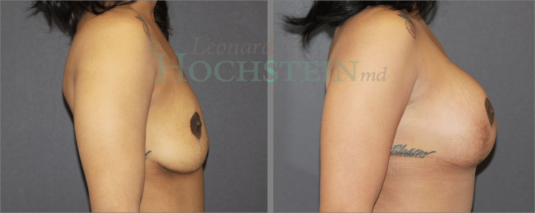 Breast Lift With Implants Patient