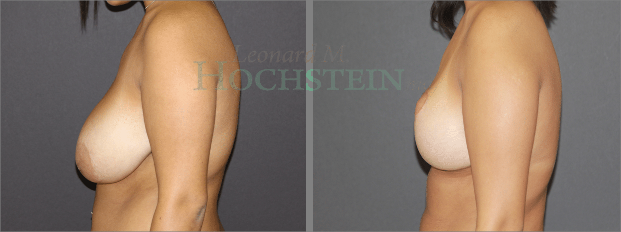 Breast Reduction/Lift (No Implants) Patient