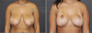 Breast Reduction/Lift (No Implants) Patient
