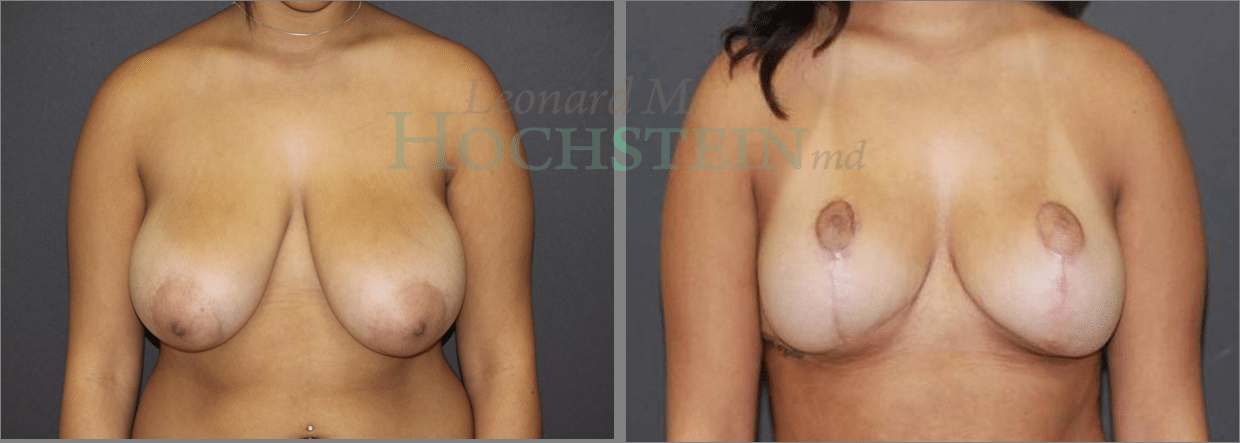 Breast Reduction/Lift (No Implants) Patient