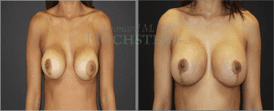 Breast Revision Patient