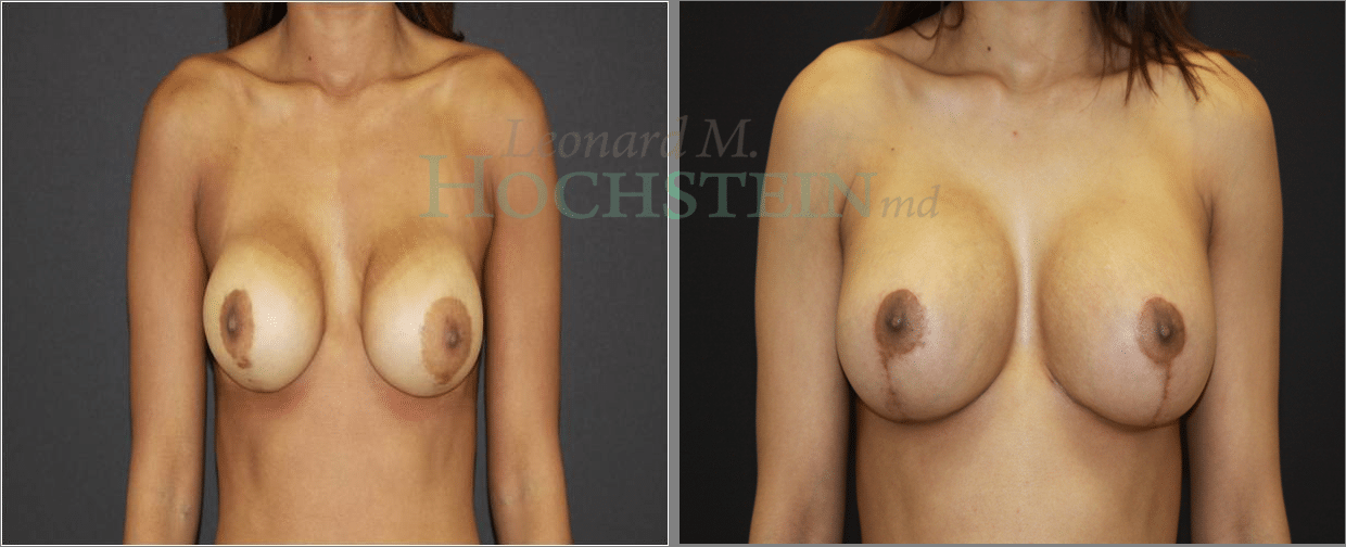 Breast Revision Patient