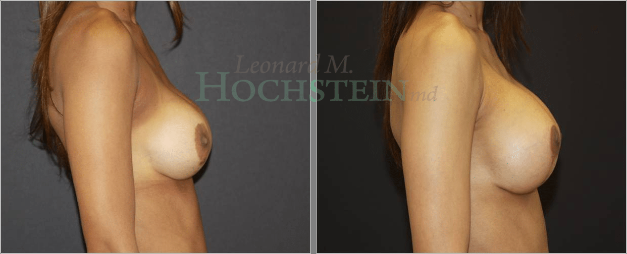 Breast Revision Patient