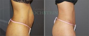 Tummy Tuck Patient