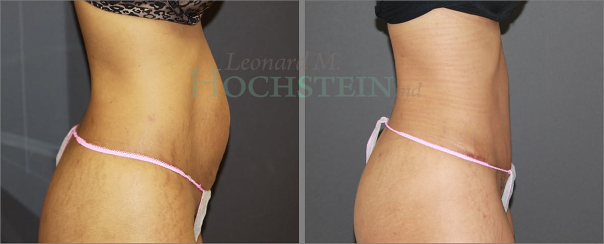 Tummy Tuck Patient