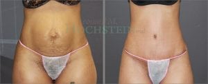 Tummy Tuck Patient