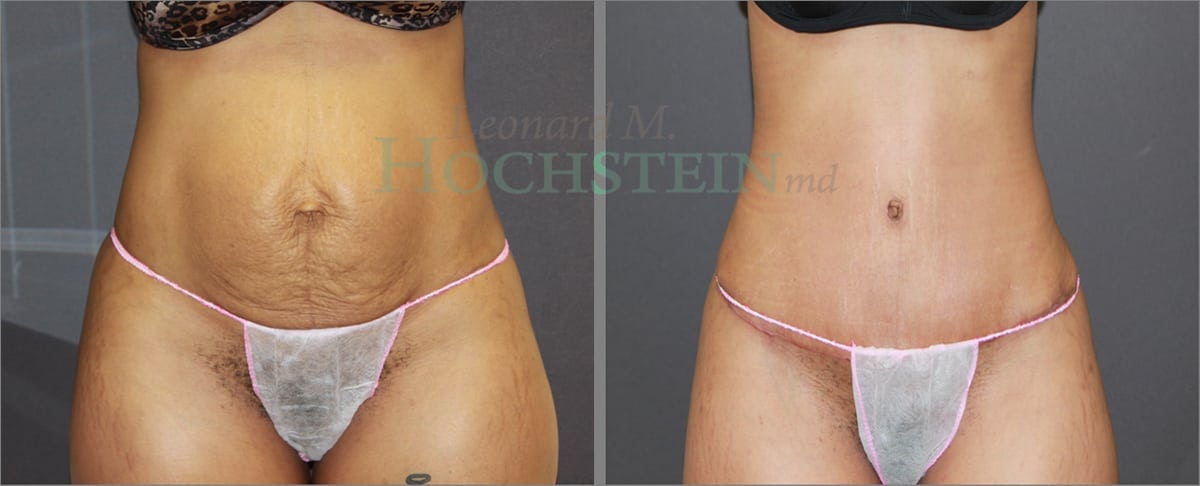 Tummy Tuck Patient