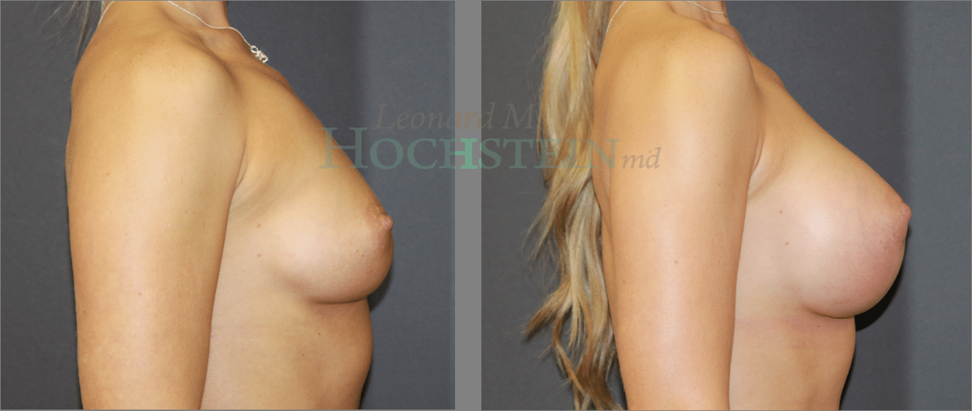 Breast Augmentation Patient