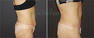 Tummy Tuck Patient