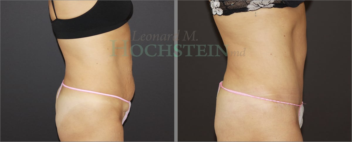 Tummy Tuck Patient
