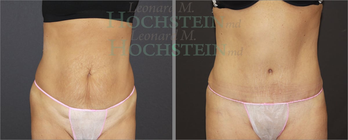 Tummy Tuck Patient